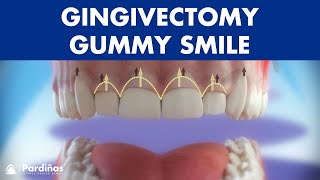 Gingivectomy  Treatment for gummy smile © [upl. by Gabriella]