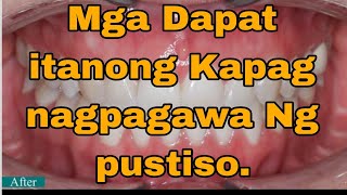 Mga Dapat itanong Kapag Ikaw ay magpapagawa Ng Pustiso [upl. by Dorsey]