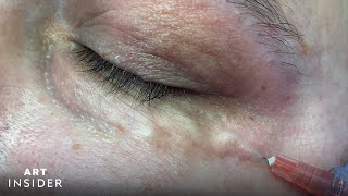 Carboxytherapy Helps Treat Dark UnderEyes [upl. by Ettelimay]