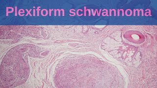 Plexiform Schwannoma  Pathology mini tutorial [upl. by Ileek]