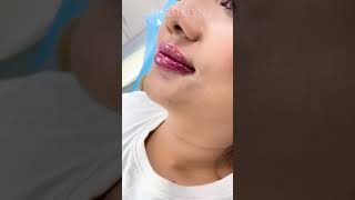 Lip Fillers Technique by Dr Muskan Tyagi  Dermalyn Aesthetics  APPOINTMENT CALL 9999189391 [upl. by Gertrudis541]