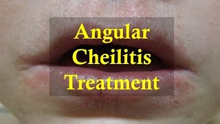 How to cure Angular Cheilitis Naturally [upl. by Crim]