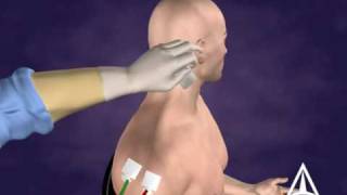 Botulinum Toxin B Injection Technique  3D Medical Animation [upl. by Whiney411]