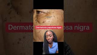 Why Do I Have These Dark Skin Spots Understanding Dermatosis Papulosa Nigra [upl. by Cosette]