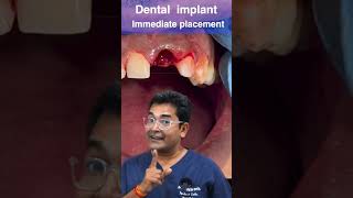 Immediate implant placement [upl. by Nylssej]