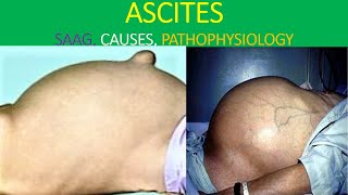 Ascites analysis explained [upl. by Lorsung274]