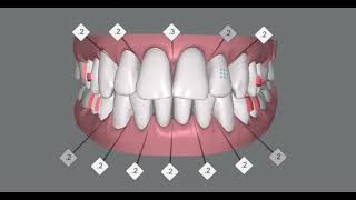 Alignment and intrusion of anterior teeth of an adult patient invisalign clincheck simulation [upl. by Harad]