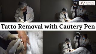 Tatto Removal with Cautery Pen  Advanced Wellness [upl. by Adil]