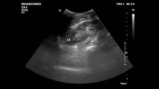 pleural fibrous tumor [upl. by Leeda838]