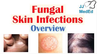 Overview of Fungal Skin Infections  Tinea Infections [upl. by Fezoj]