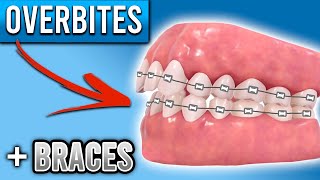 Braces Before and After  Part 3  Orthodontic treatment [upl. by Bernice]