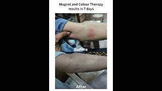 Herpes Zoster Results in 7 days by Magnet and Colour Therapy herpesvirus virotherapy arogyam [upl. by Nivlam204]