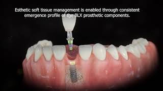 Straumann® BLX Implant System  Consistent Emergence Profile [upl. by Domeniga615]