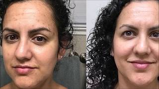 Meladerm Before and After Pictures Amazing Results [upl. by Nalod]