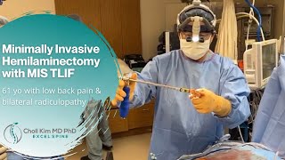 Minimally Invasive Hemilaminectomy w MIS TLIF [upl. by Atiuqes942]