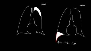 The deep sulcus sign of supine pneumothorax [upl. by Sakmar]