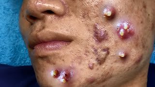 Big Cystic Acne Blackheads Extraction Blackheads amp Milia Whiteheads Removal Pimple Popping 095 [upl. by Harv906]