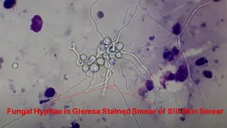 Fungal hyphae in GiemSa stained slit skin smear under the Microscope [upl. by Milo]