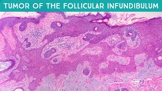 Tumor of the follicular infundibulum TFI  dermpath in 5 minutes dermatology pathology [upl. by Irwin]