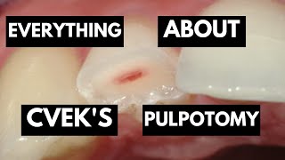 Master Your Concepts for Cveks Pulpotomy  Everything You Need To Know [upl. by Jehial]