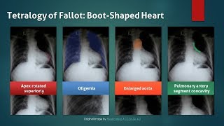 Tetralogy of Fallot Explanation of Chest Xray Findings Boot Shaped Heart [upl. by Fiona]