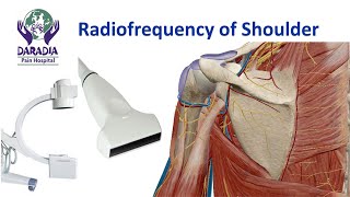 Shoulder Joint Radiofrequency Procedure  Cooled RF of shulder [upl. by Moss343]