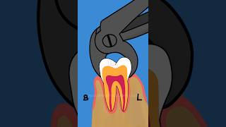 Extraction of Broken Root Piece drteeth dentistry [upl. by Arramahs]