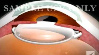 Eye Surgery Cataract with Lens Replacement [upl. by Ronoh]