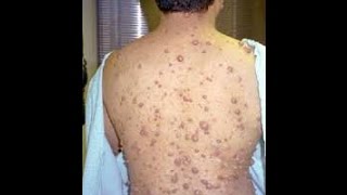 pediatrics  Neurocutaneous syndroms 1  Neurofibromatosis 12 Tuberous sclerosis complex [upl. by Elberta]