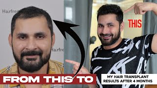 My Hair Transplant Experience after 4 Months  Revealing all secrets of my hair growth  Vlog [upl. by Tillio]