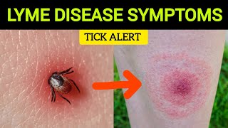 Early Signs of Lyme Disease What to Watch For [upl. by Danforth]