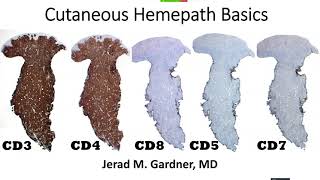 Cutaneous Hemepath 101 Skin Lymphoma Leukemia amp Histiocytic Infiltrate Basics Hematopathology [upl. by Ayanaj]