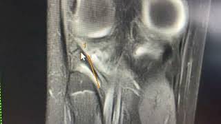 Fractura osteocondral vs ostecondritis disecante [upl. by Ynahirb]