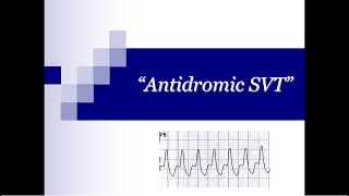 ECG Tip 21 What about quotAntidromicquot SVT [upl. by Eivod]