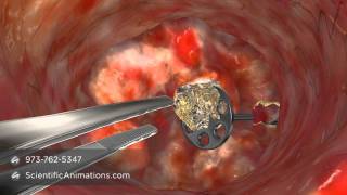 Medical Animation of CO2 Laser Surgery [upl. by Gradey]