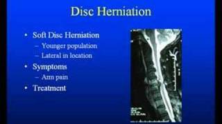 Neck or Arm Pain from Disc Herniation Arthritis or Stenosis [upl. by Canica]