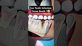 Tooth Infection 🦷toothache dentistry viralshorts MedicalStuffSHF07 [upl. by Marquis240]