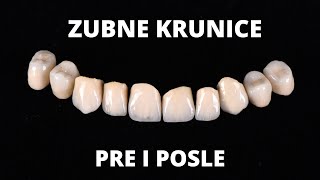 Zubne krunice boja A2 [upl. by Enirehtak]