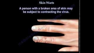 Skin Warts  Hand warts  Everything You Need To Know  Dr Nabil Ebraheim [upl. by Chiarra20]