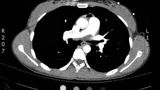 Chest Pneumomediastinum Axial CT JETem 2018 [upl. by Erreip]