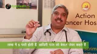 बेसिल सेल कार्सिनोमा और इसके लक्षण  Onlymyhealthcom [upl. by Helsell225]