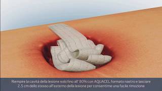 ConvaTec  AVELLE™ Sistema di terapia a pressione negativa Lesioni Profonde [upl. by Asila]