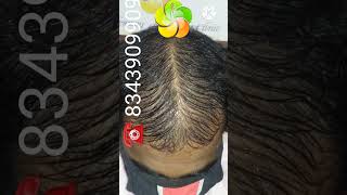 Hair Treatment  PRP treatment for hair loss  PRP  shorts [upl. by Drahcir]