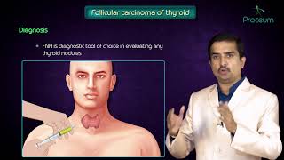 Thyroid neoplasms part 2  Follicular carcinoma of thyroid   Endocrine pathology [upl. by Edorej]