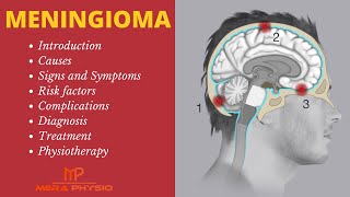 Meningioma  Intro Causes Symptoms Complications Diagnosis Physiotherapy Treatment Mera Physio [upl. by Ailime]