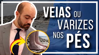 🔴 Veias e Varizes nos PÉS Por que aparecem Quando é normal [upl. by Fairbanks]