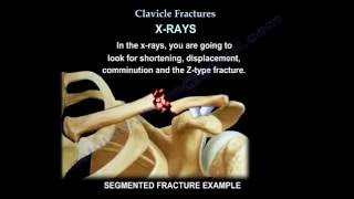 Clavicle Fractures  Everything You Need To Know  Dr Nabil Ebraheim [upl. by Llehsar]