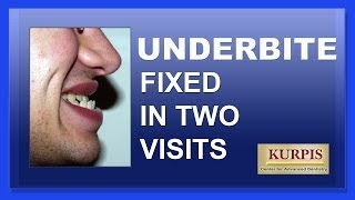 Fix Underbite Without Orthognathic Surgery [upl. by Leone719]