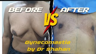 Gynecomastia Surgery amazing results [upl. by Yrtnahc]