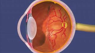 retinopathy of Prematurity  RetCam  The Medical City [upl. by Bathelda376]